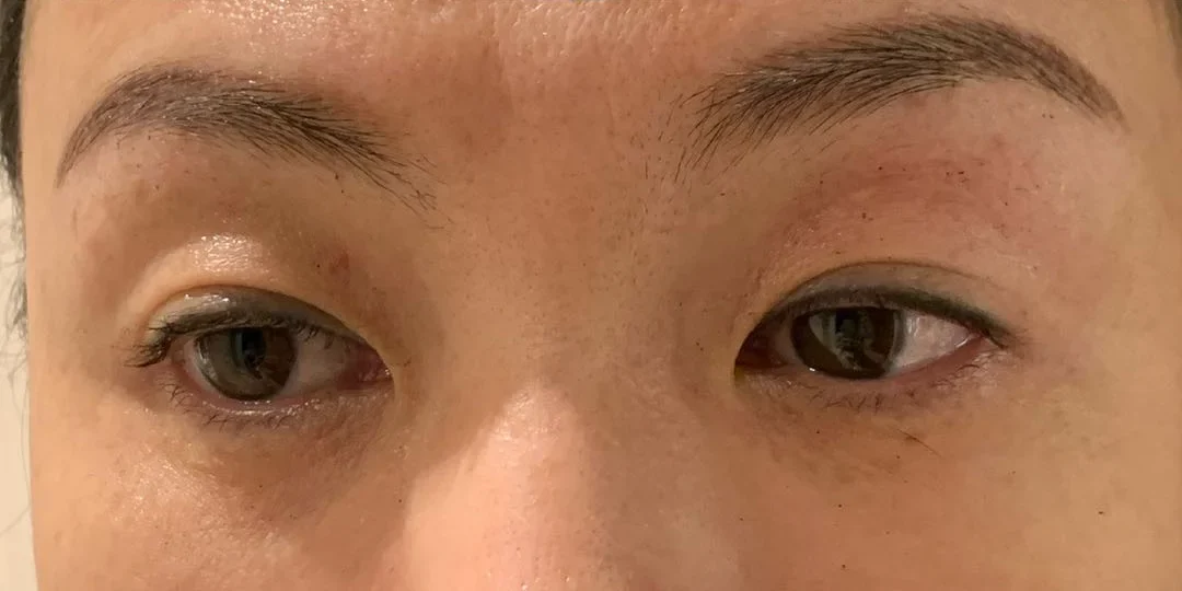 Thermage FLX — after
