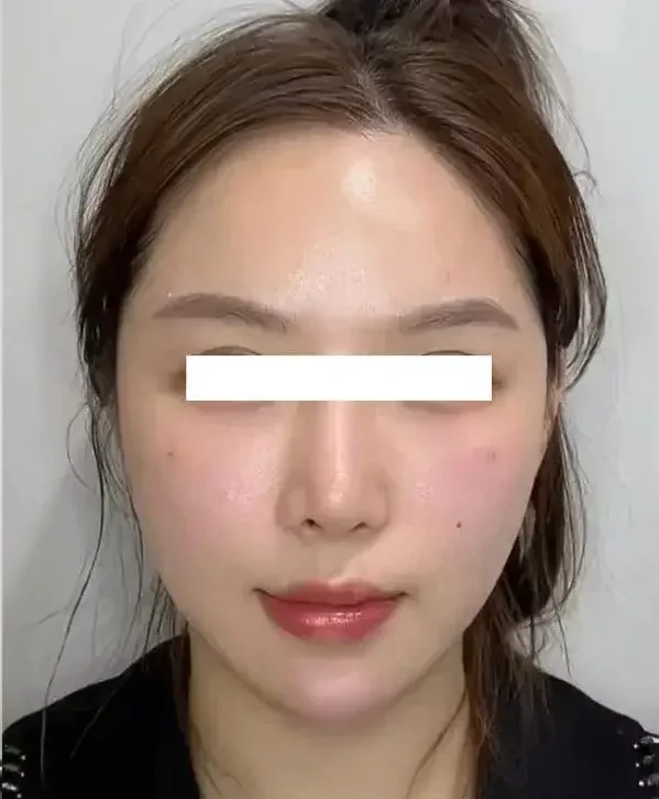 Thermage FLX — after