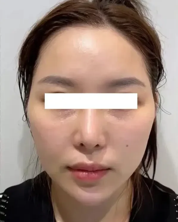 Thermage FLX — before
